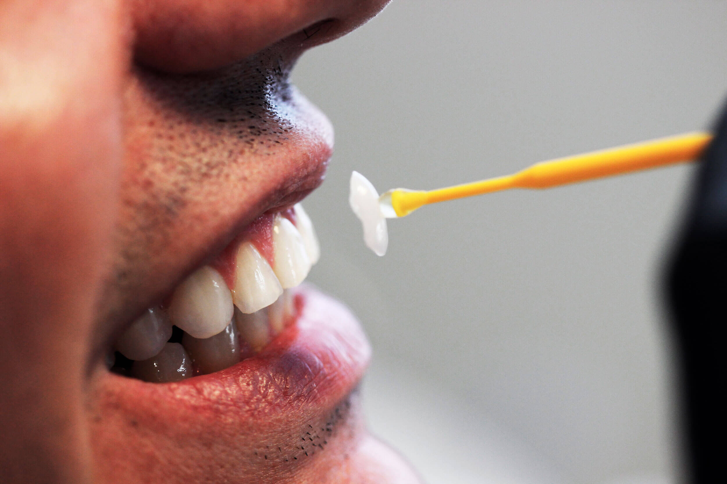Lentes de Contato Dental | Dentista em Fortaleza - Dr. André Pessoa